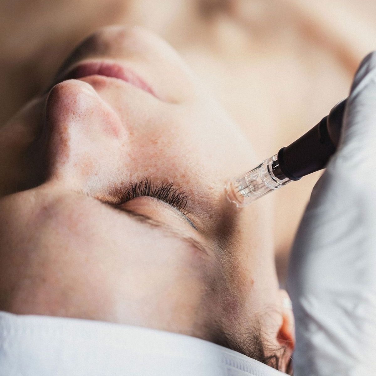 МЕДИЦИНСКИ МИКРОНИДЛИНГ С AMIAMED REVIVE + ХИДРАТИРАЩА МЕЗОТЕРАПИЯ