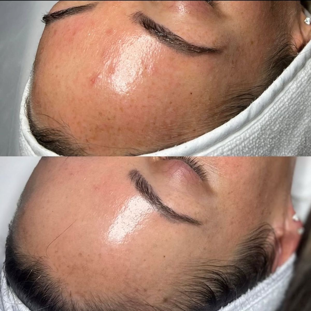 MELA PEEL ЗА УПОРИТИ ПИГМЕНТАЦИИ - Image 2