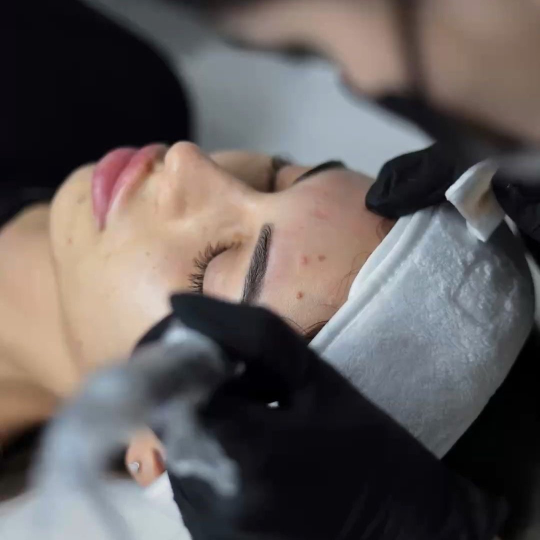 МЕДИЦИНСКИ МИКРОНИДЛИНГ С AMIAMED REVIVE + МЕЗОТЕРАПИЯ С ЕКЗОЗОМИ