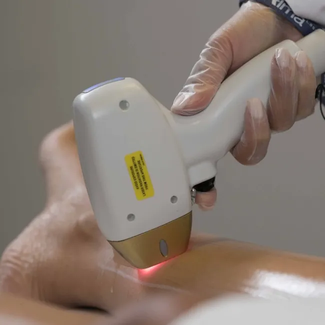 ЛАЗЕРНА ЕПИЛАЦИЯ С DIOLAZE XL ALMA BEAUTY И SOPRANO ICE ЗА ЛИЦЕ / ЖЕНИ - Image 2